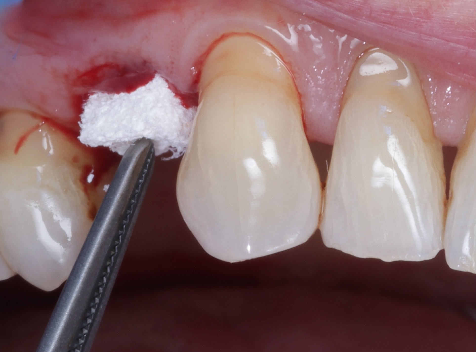 Clinical photo of Ridge Preservation
