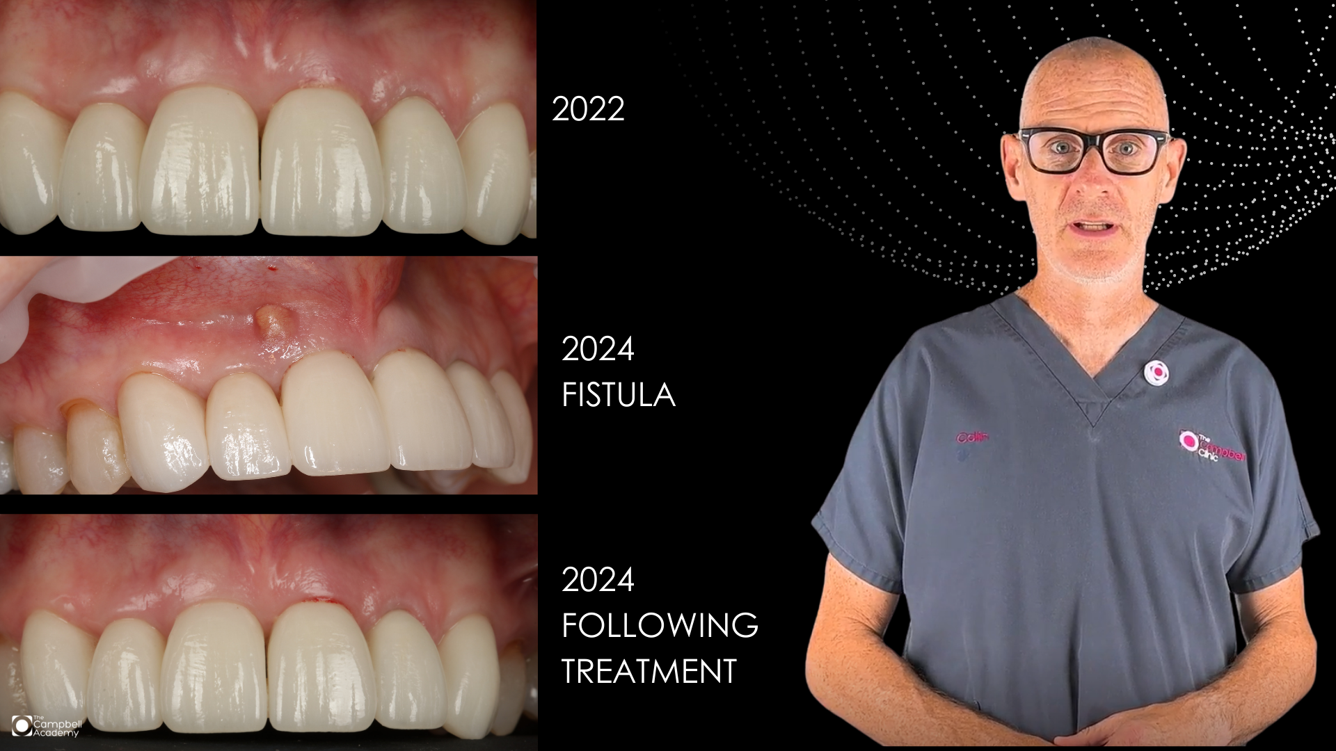 CC Clubhouse case, Soft Tissue Reconstruction (1)